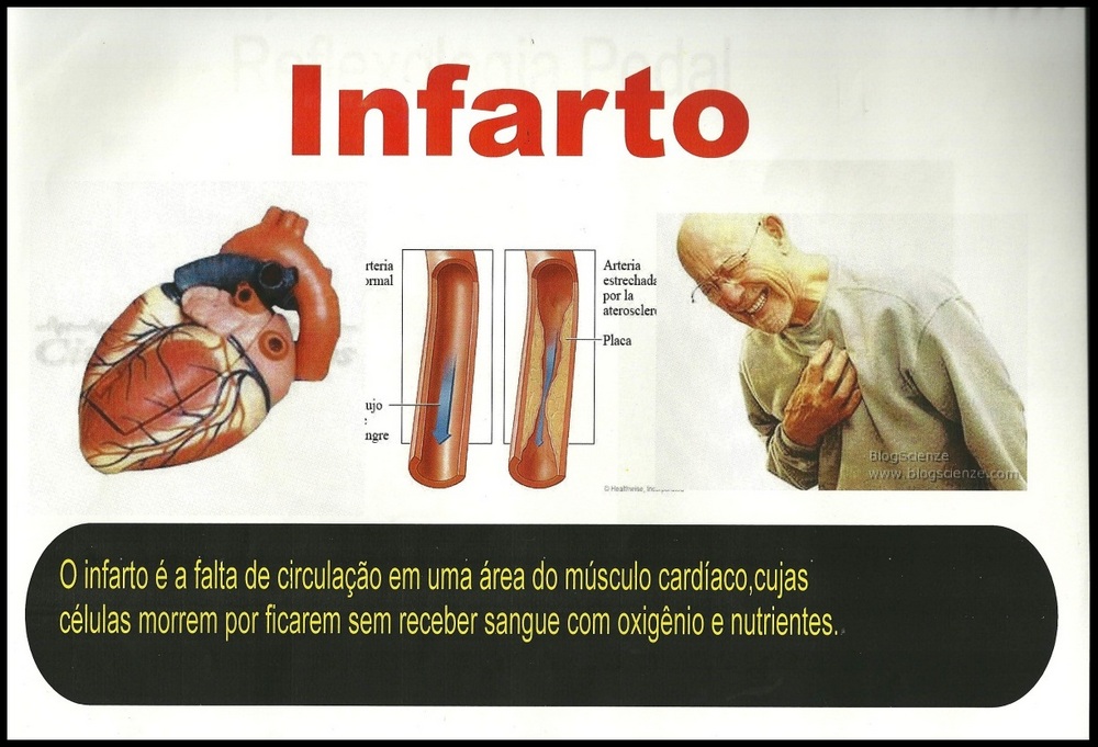 Infarto